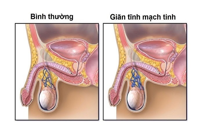 Hình ảnh khi bị giãn tĩnh mạch thừng tinh